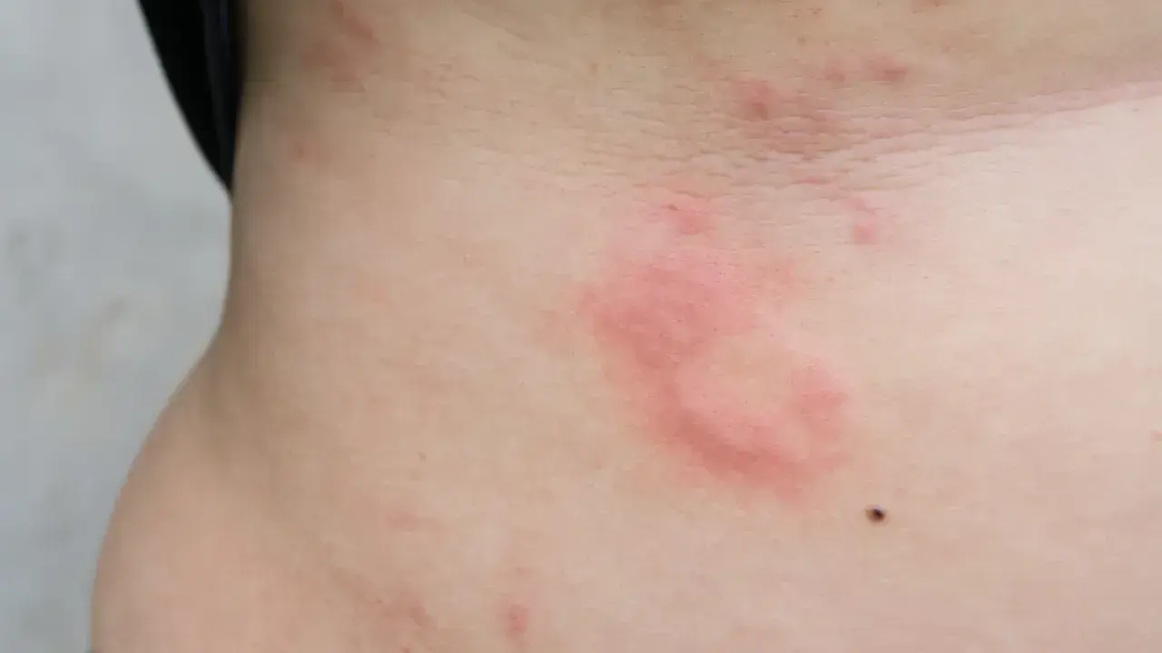 Czerwone, swędzące plamy na skórze, które mogą być objawem uczulenia na soję.