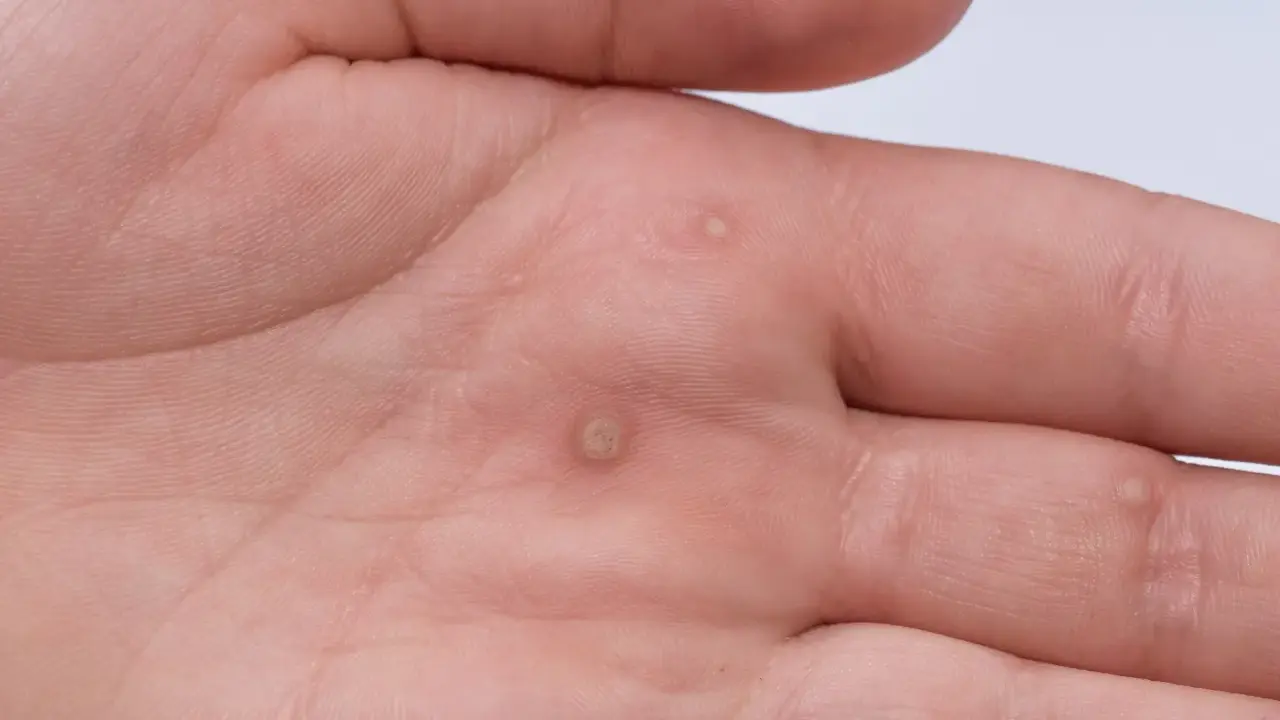 Dłoń mężczyzny z kilkoma brodawkami, które mogą być objawem wirusa HPV. Widoczne zmiany skórne na wewnętrznej stronie dłoni.