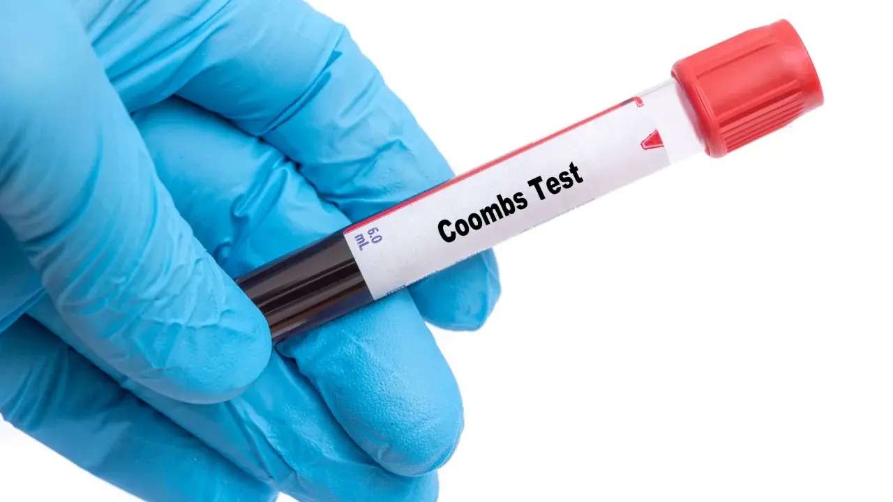 Rękawiczka w niebieskiej rękawiczce trzyma probówkę z krwią do badania. Na etykiecie widnieje napis "Coombs Test", kluczowy dla oceny odczynu Coombsa w ciąży.