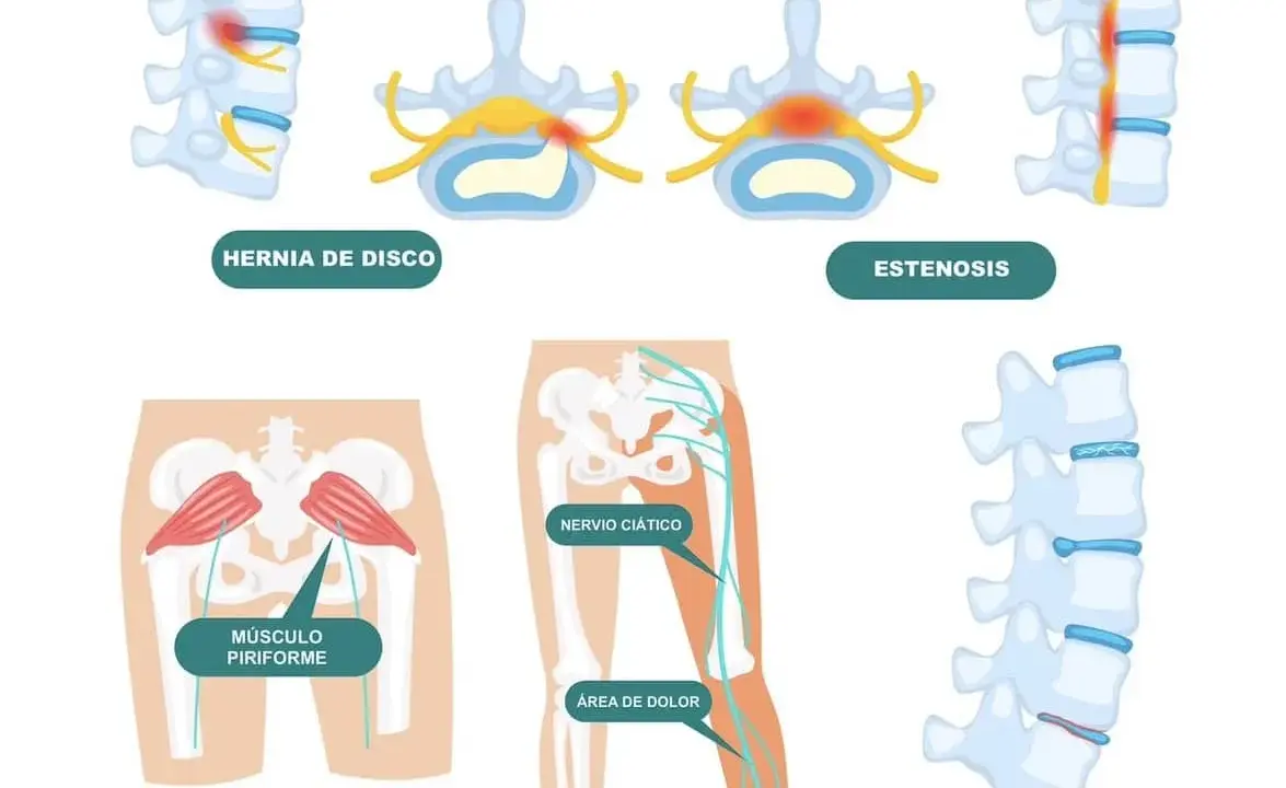 ¿Es ciática? Reconoce síntomas, causas y cuándo actuar