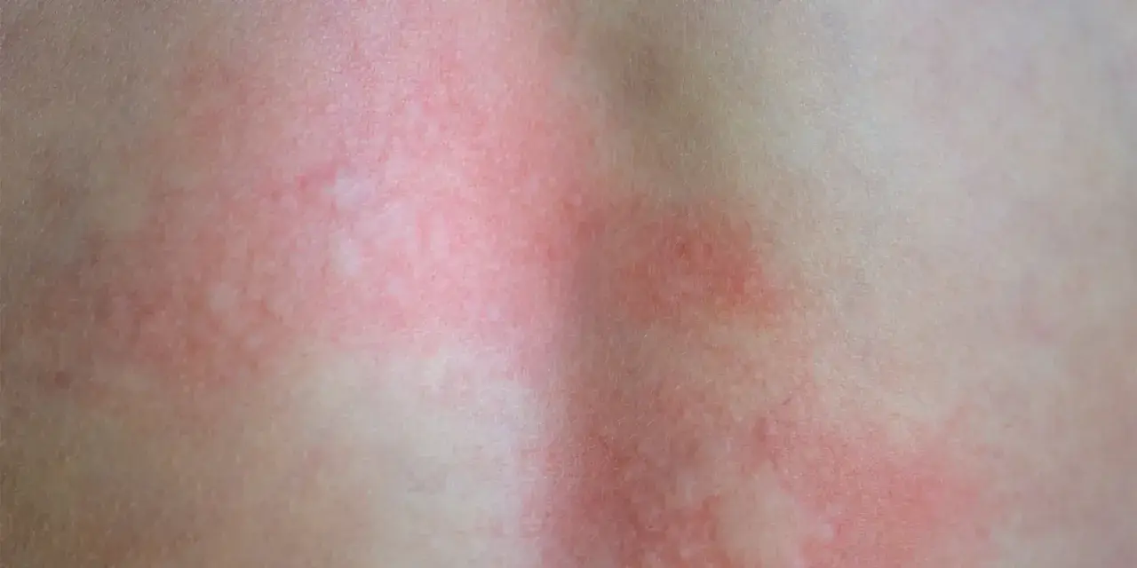 Rozległy, czerwony rumień na skórze, który może pojawić się po ukąszeniu kleszcza.