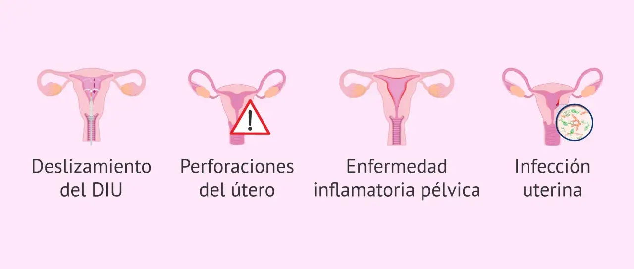 Ilustración de útero con DIU, deslizamiento, perforación, enfermedad inflamatoria pélvica e infección uterina. Reposo tras colocar el DIU Mirena.