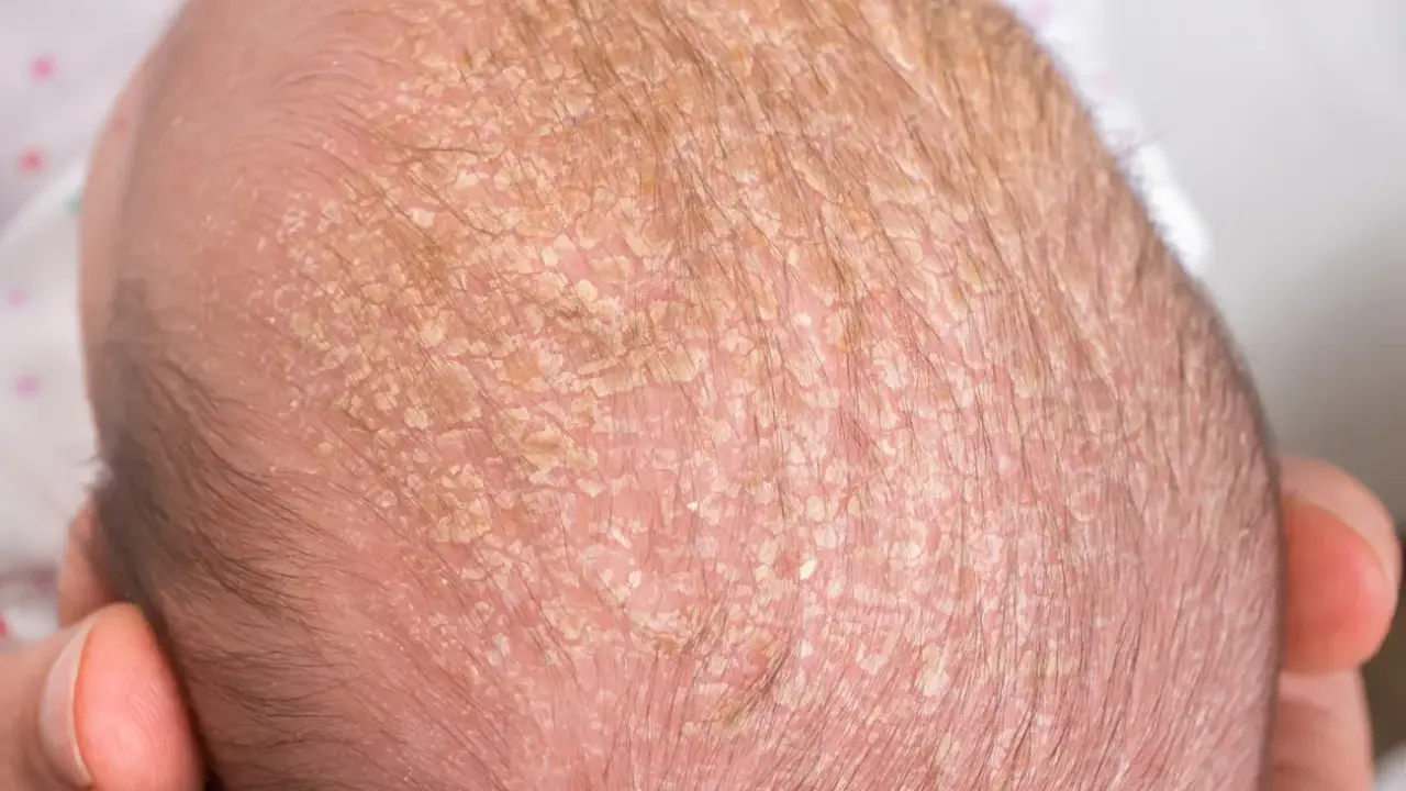 Testa di neonato con crosta lattea, squame giallastre e sottili capelli scuri.
