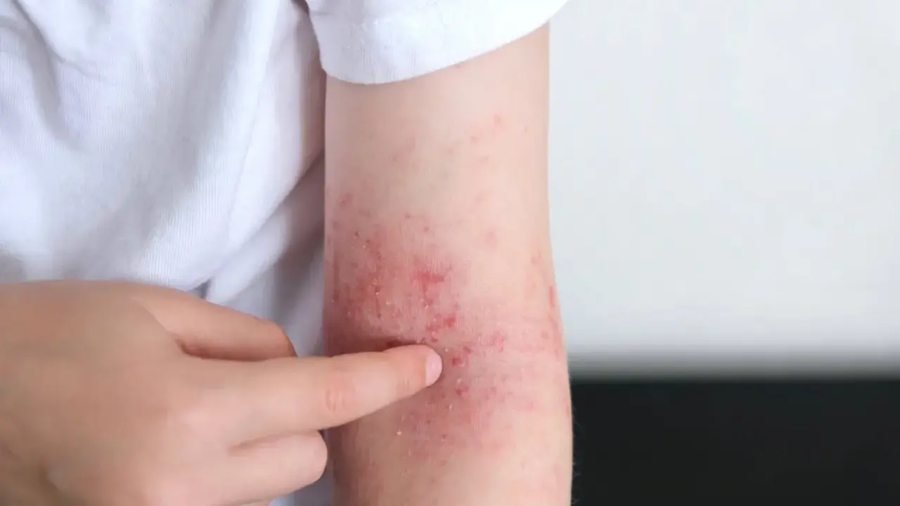 Un bras montre des rougeurs et des irritations, signe d'un possible stress peau.