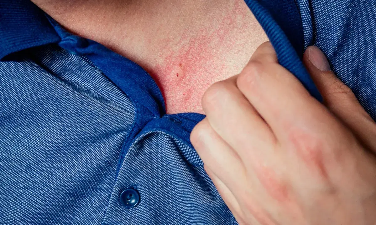 Pelle arrossata e irritata sul collo, possibile dermatite da stress. Una mano solleva il colletto di una camicia blu.