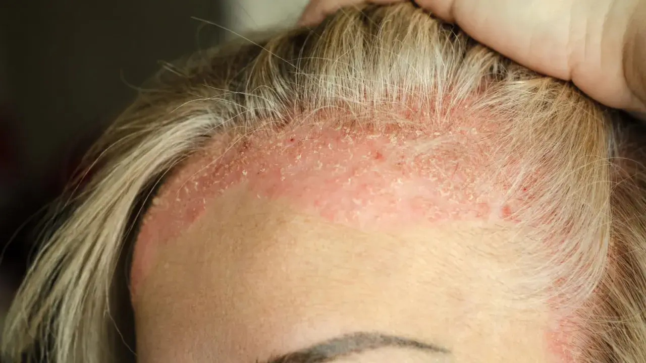 Cuir chevelu irrité avec des plaques rouges et des squames de peau morte, près des cheveux blonds.
