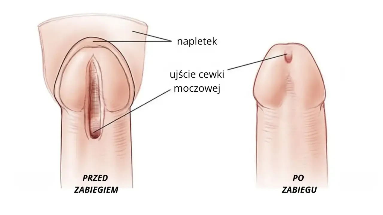 Przed i po zabiegu: widok penisa z napletkiem i ujściem cewki moczowej.