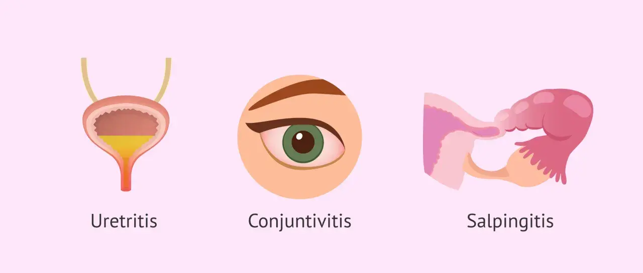 Ilustración muestra uretritis, conjuntivitis y salpingitis, afecciones que puede causar la clamidia.