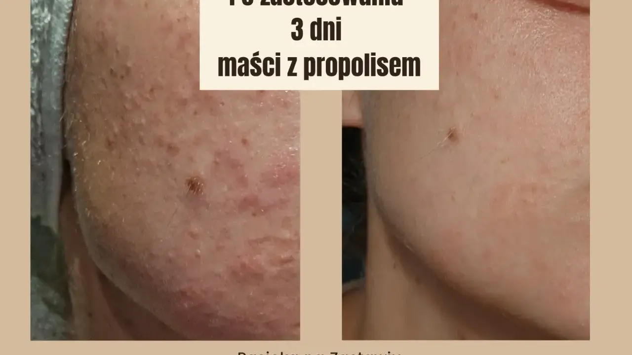 Przed i po 3 dniach stosowania maści z propolisem. Skóra z niedoskonałościami staje się gładsza.
