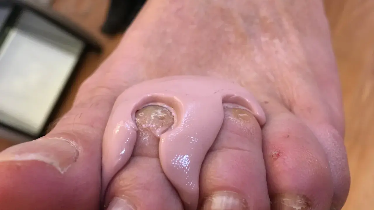 Orthoplastie podologue : un pansement rose est appliqué entre les orteils pour soulager une douleur.