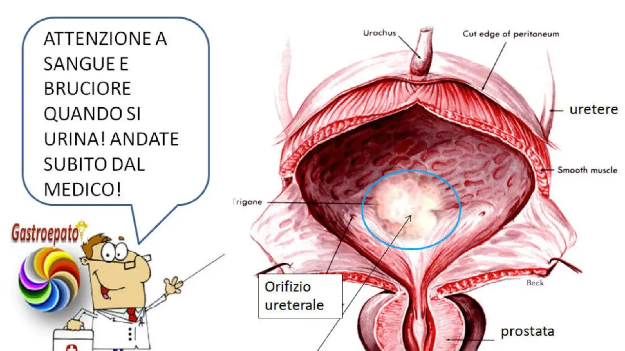 Illustrazione anatomica della vescica maschile con un'area evidenziata che indica un tumore alla vescica. Avviso: sangue e bruciore durante la minzione richiedono visita medica immediata.