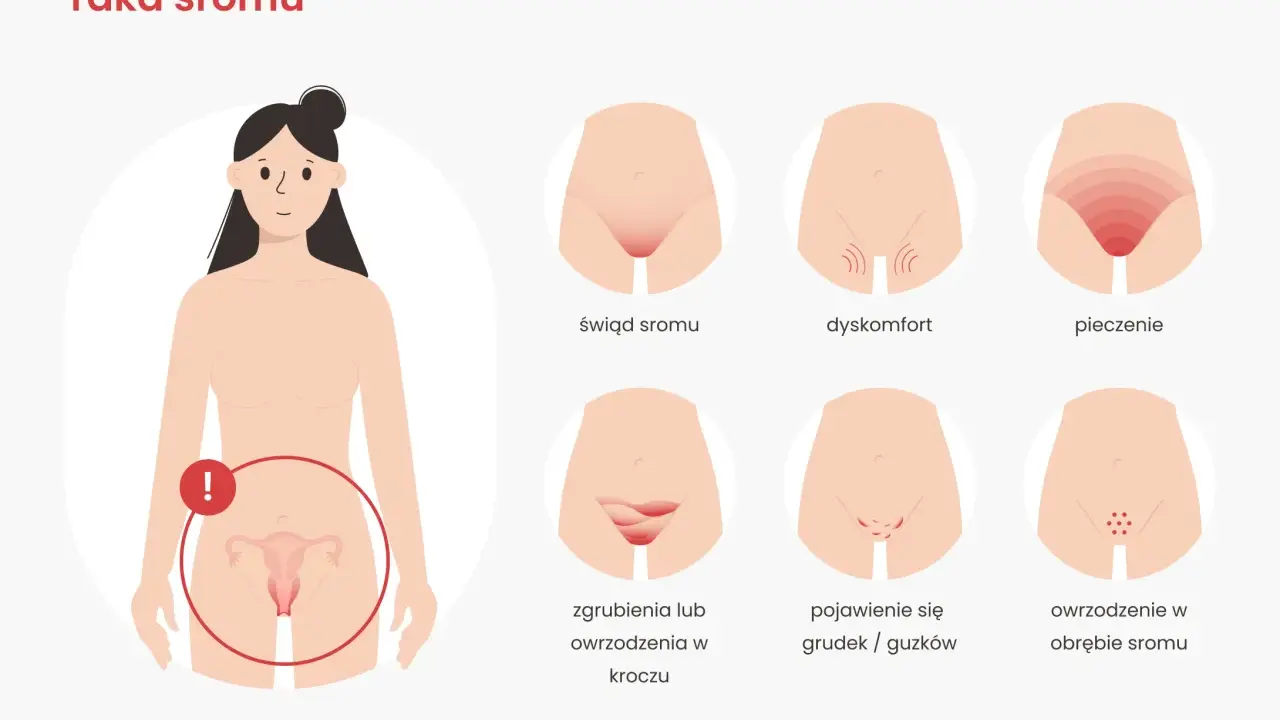 Ilustracja pokazuje wczesne objawy raka sromu: świąd, pieczenie, dyskomfort, zgrubienia, grudki i owrzodzenia.