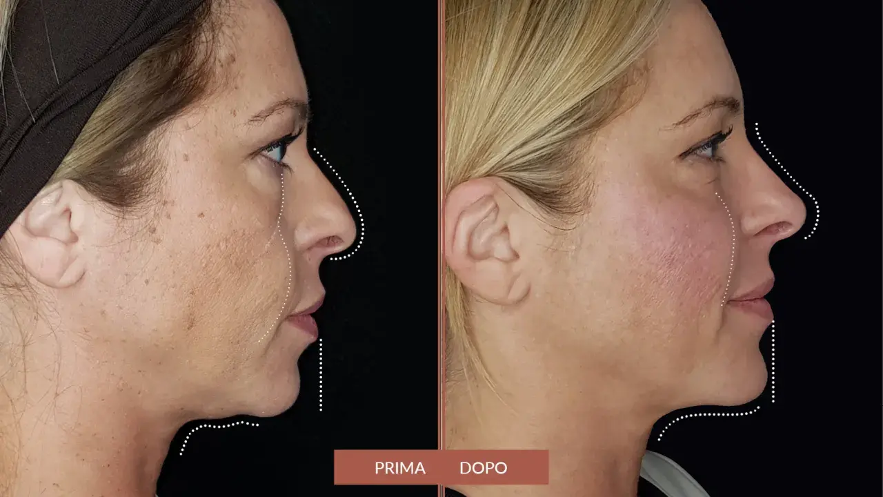 Prima e dopo: il filler full face ha ridefinito i contorni del viso, migliorando la pienezza e la definizione.