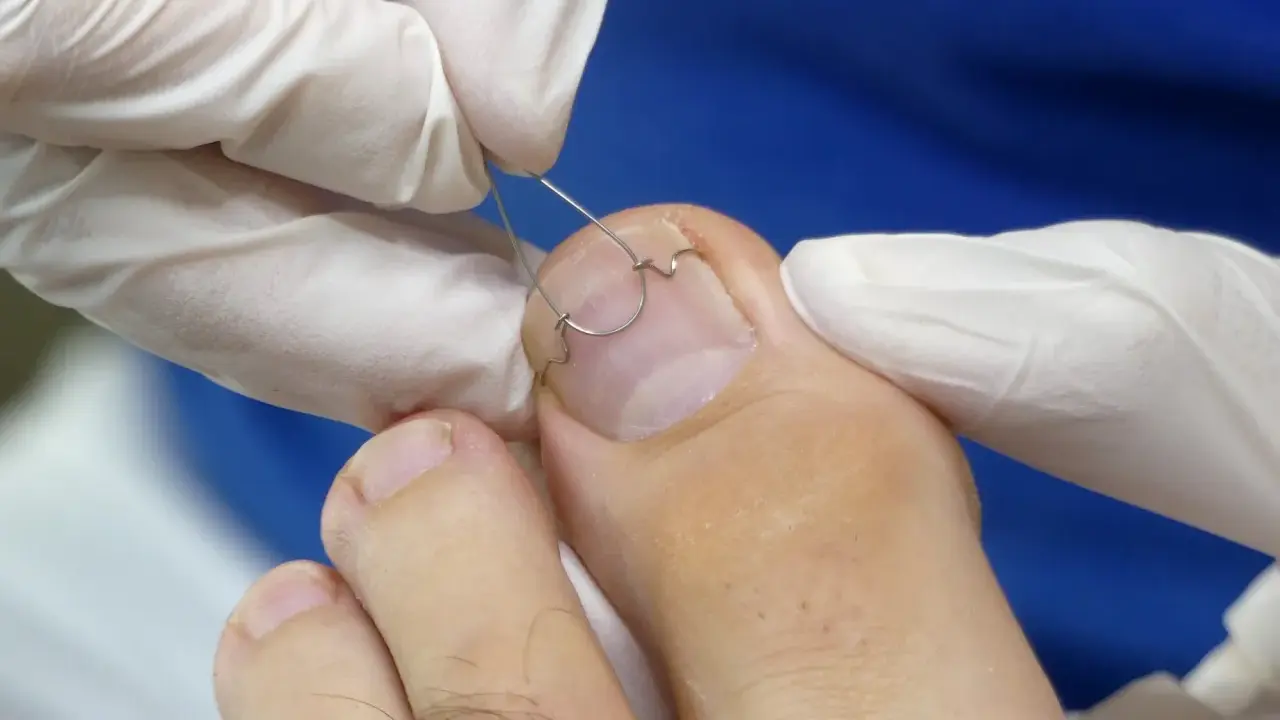 Application d'une orthonyxie sur un ongle incarné. Des mains gantées ajustent un fil métallique pour corriger la courbure de l'ongle.