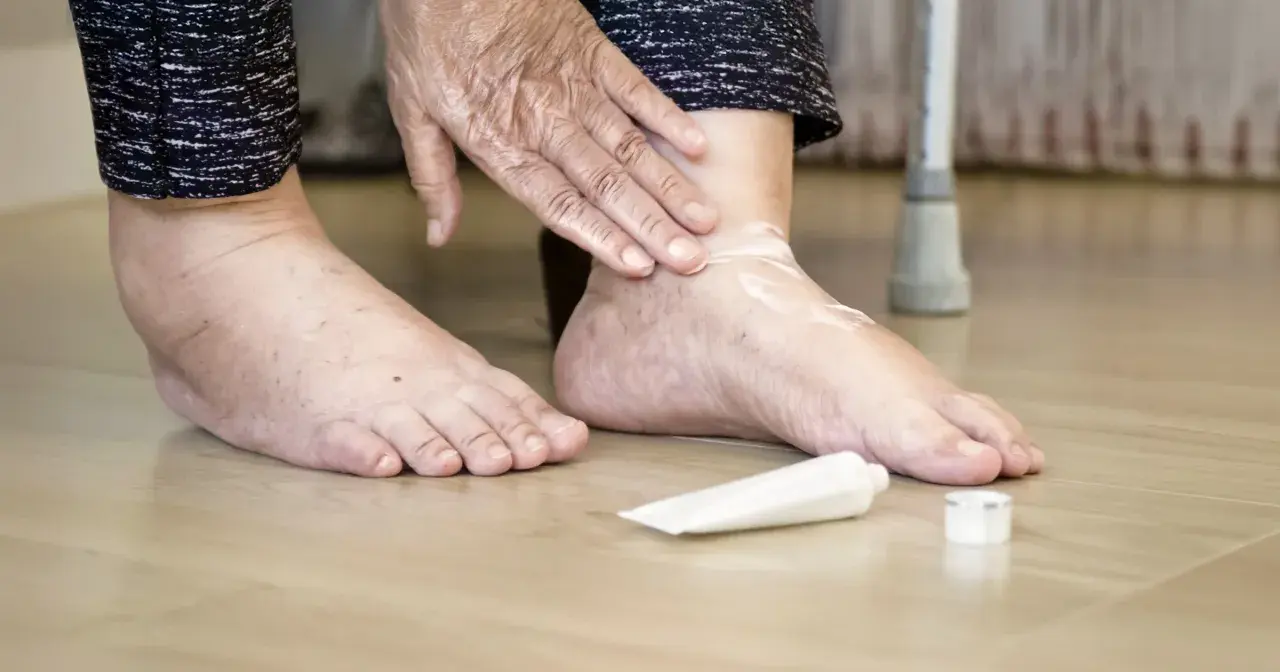 Osoba smaruje stopę kremem, łagodząc ból dużego palca w stopie, który może być związany z cukrzycą.