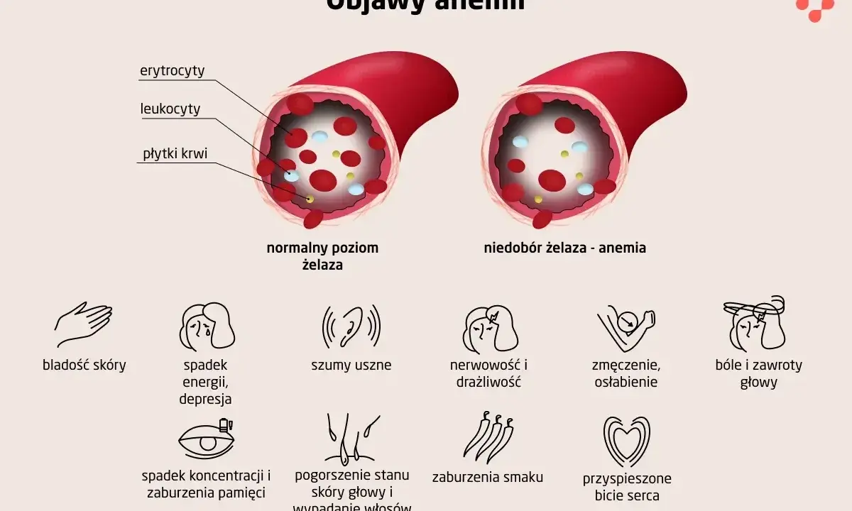 Objawy anemii: bladość, zmęczenie, bóle głowy. Leczenie anemii jest kluczowe dla poprawy samopoczucia.