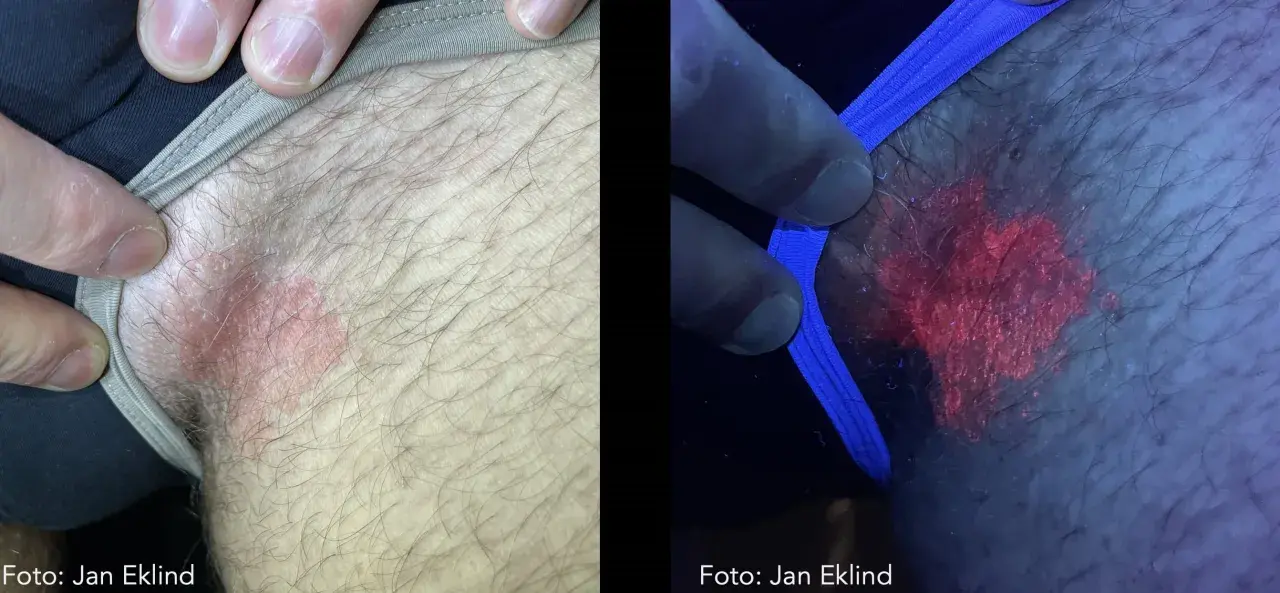Hudförändring som kan vara leishmania hos människa. Till vänster syns en röd, fjällande fläck. Till höger, under UV-ljus, lyser fläcken starkt rött.