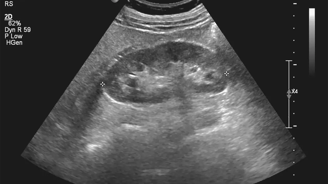 Badanie USG nerki prawej. Obraz pokazuje strukturę nerki, z zaznaczonymi pomiarami. Pytanie, czy torbiel na nerce może się wchłonąć, jest kluczowe w diagnostyce.