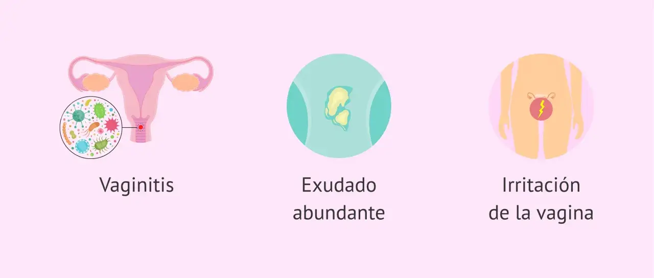 Ilustración de vaginitis, exudado y picazón vaginal, síntomas comunes de tricomoniasis.