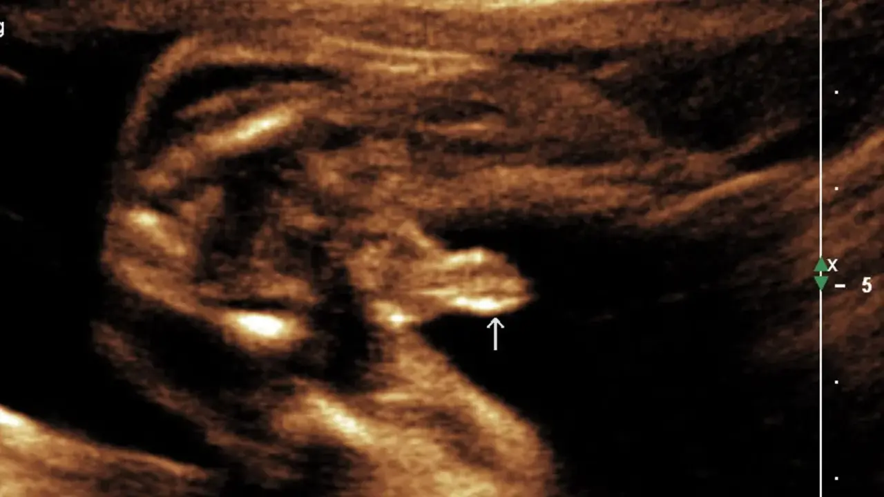 Ultraschallbild eines Babys in der 20. SSW. Der Pfeil zeigt auf die Genitalien, die auf XY-Chromosomen hindeuten.