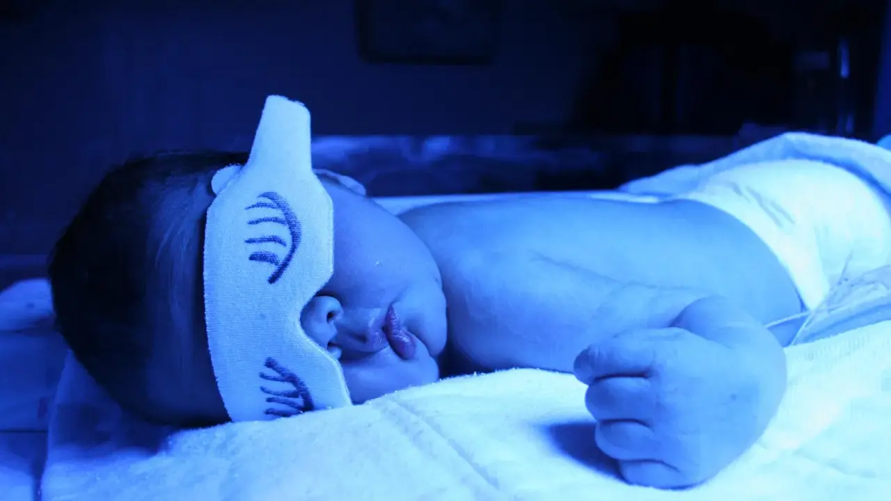 Neonato sotto lampada blu per curare l'ittero, con mascherina protettiva sugli occhi.