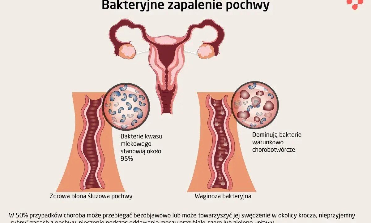 Ilustracja porównuje zdrową pochwę z dominującymi bakteriami kwasu mlekowego do waginozy bakteryjnej, gdzie przeważają bakterie chorobotwórcze.
