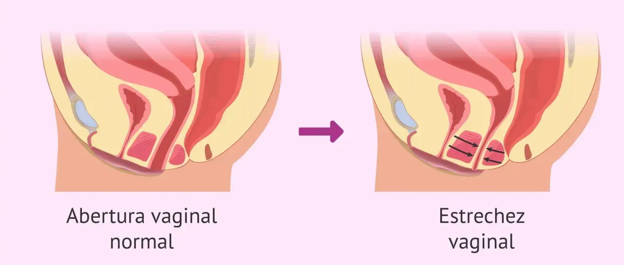 Ilustración comparativa de la abertura vaginal normal y la estrechez vaginal, donde se aprecian espasmos musculares en la segunda.