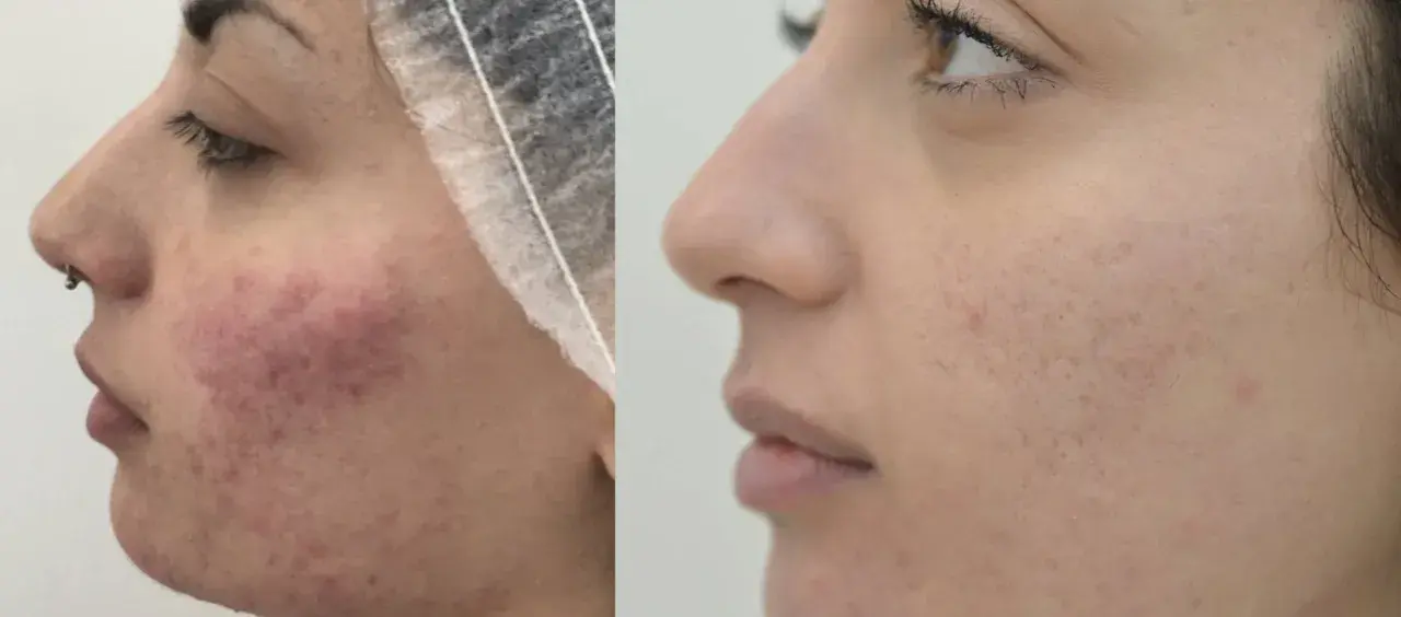 Prima e dopo: pelle con acne e rossori, poi migliorata. Nessun effetto collaterale visibile di Dermamelan.