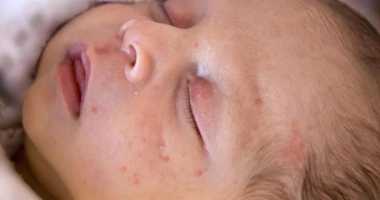 Skóra niemowlęcia z zaczerwienieniami i krostkami. Czy to trądzik niemowlęcy, czy może alergia?