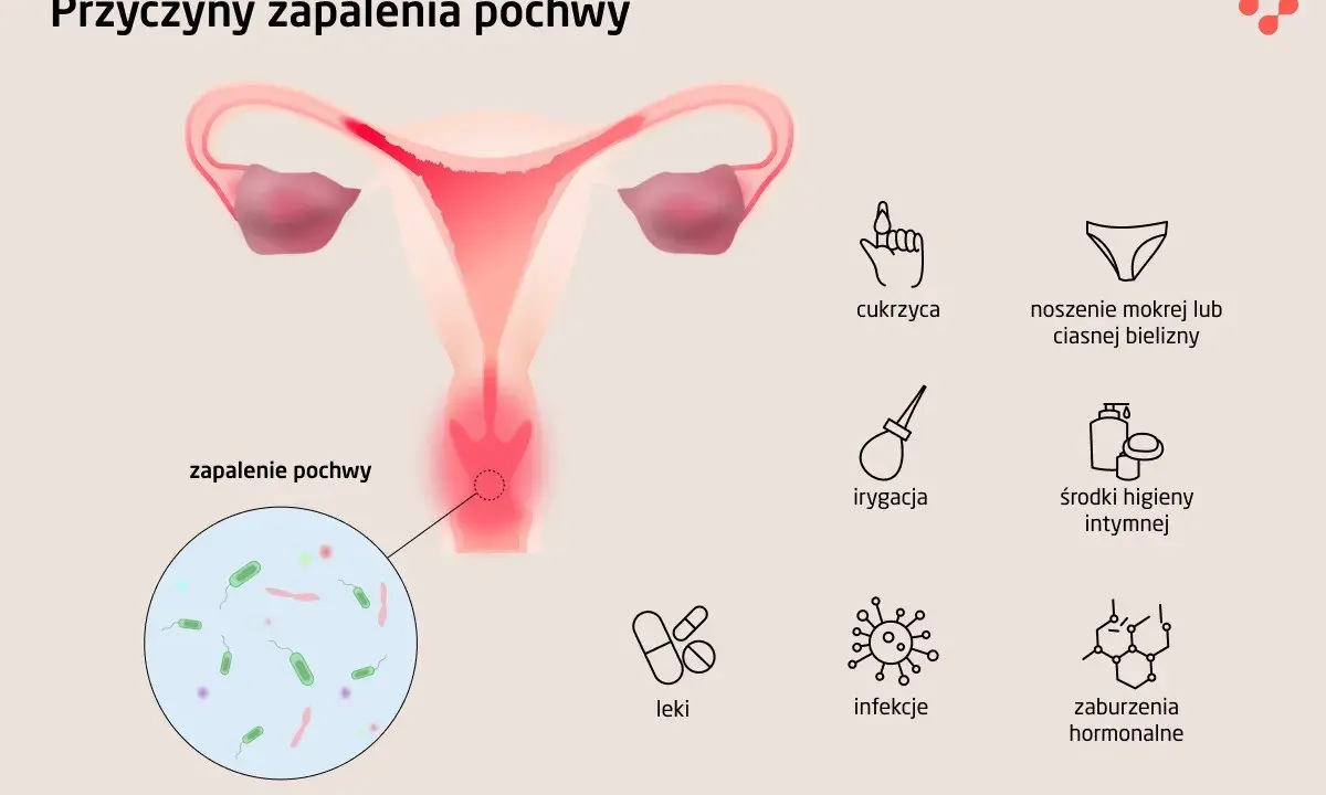 Ilustracja przedstawia przyczyny zapalenia pochwy: cukrzyca, mokra bielizna, irygacja, środki higieny intymnej, leki, infekcje, zaburzenia hormonalne.