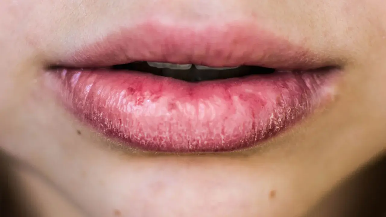 Labbra secche e screpolate, con segni di irritazione. Le cause possono essere molteplici, dal freddo alla disidratazione.