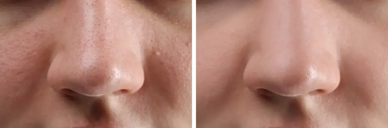 Avant/après : peau du nez avec points noirs avant et après extraction, montrant une peau plus lisse et nette.