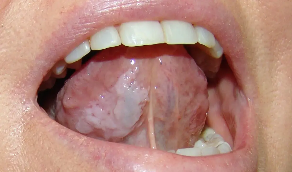 Lingua con aree biancastre, possibile leucoplachia, che potrebbe indicare un tumore alla lingua.