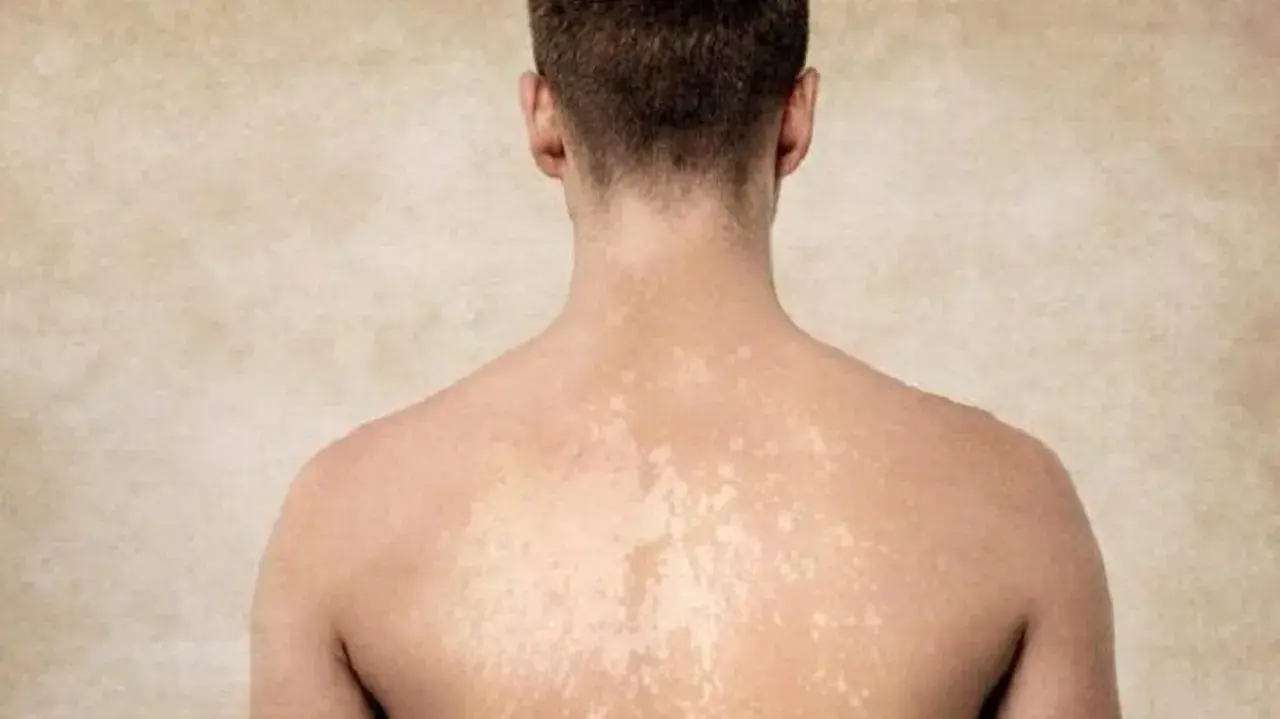Dos de homme montrant des taches blanches sur la peau, possiblement dues à une exposition au soleil.