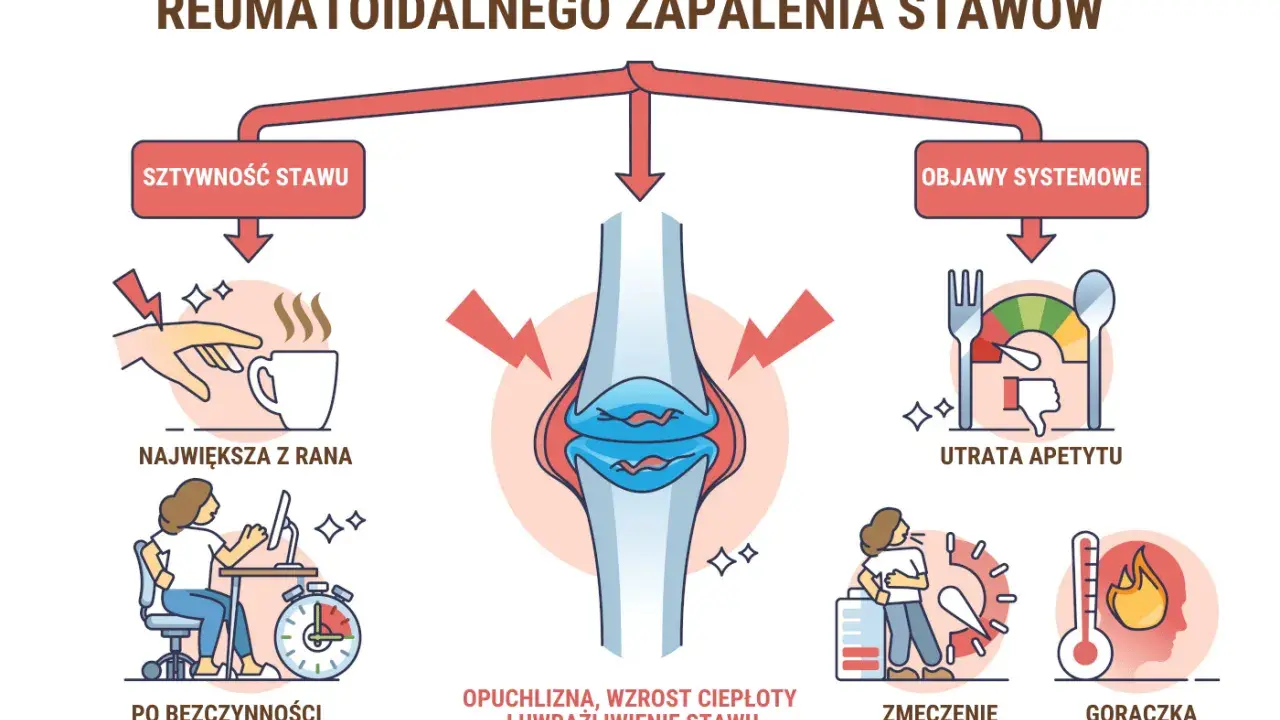 Wczesne oznaki reumatoidalnego zapalenia stawów: sztywność, opuchlizna, zmęczenie, gorączka, utrata apetytu. Test na RZS.