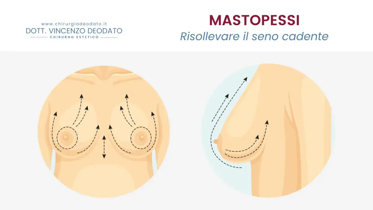 Mastopessi: solleva il seno cadente. Immagine illustra il seno prima e dopo il sollevamento, con frecce che indicano il movimento verso l'alto.
