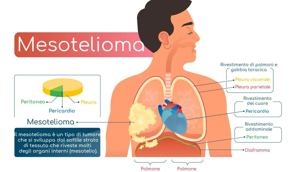 Il mesotelioma è un tumore che colpisce il mesotelio, il sottile strato che riveste gli organi interni. L'immagine mostra dove può svilupparsi.