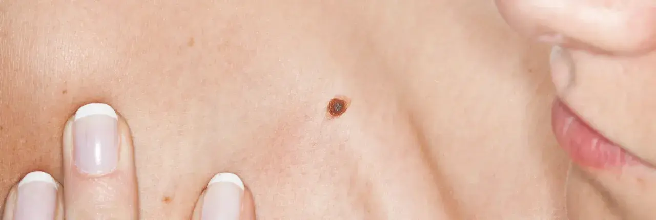 Gros plan sur une peau humaine, montrant une texture légèrement granuleuse, un grain de beauté brun et le bord des lèvres.