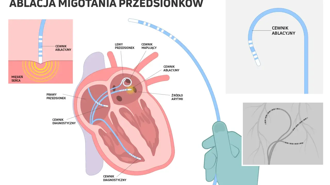 Ilustracja przedstawia zabieg ablacji migotania przedsionków, gdzie cewniki diagnostyczne i ablacyjne docierają do serca, by zlokalizować i zniszczyć źródło arytmii.