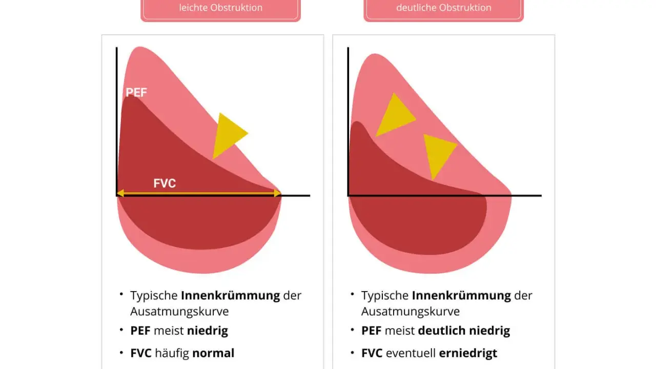 Diagramm zeigt Lungenfunktion bei Asthma. Links leichte Obstruktion mit PEF meist niedrig, rechts deutliche Obstruktion mit PEF deutlich niedrig.