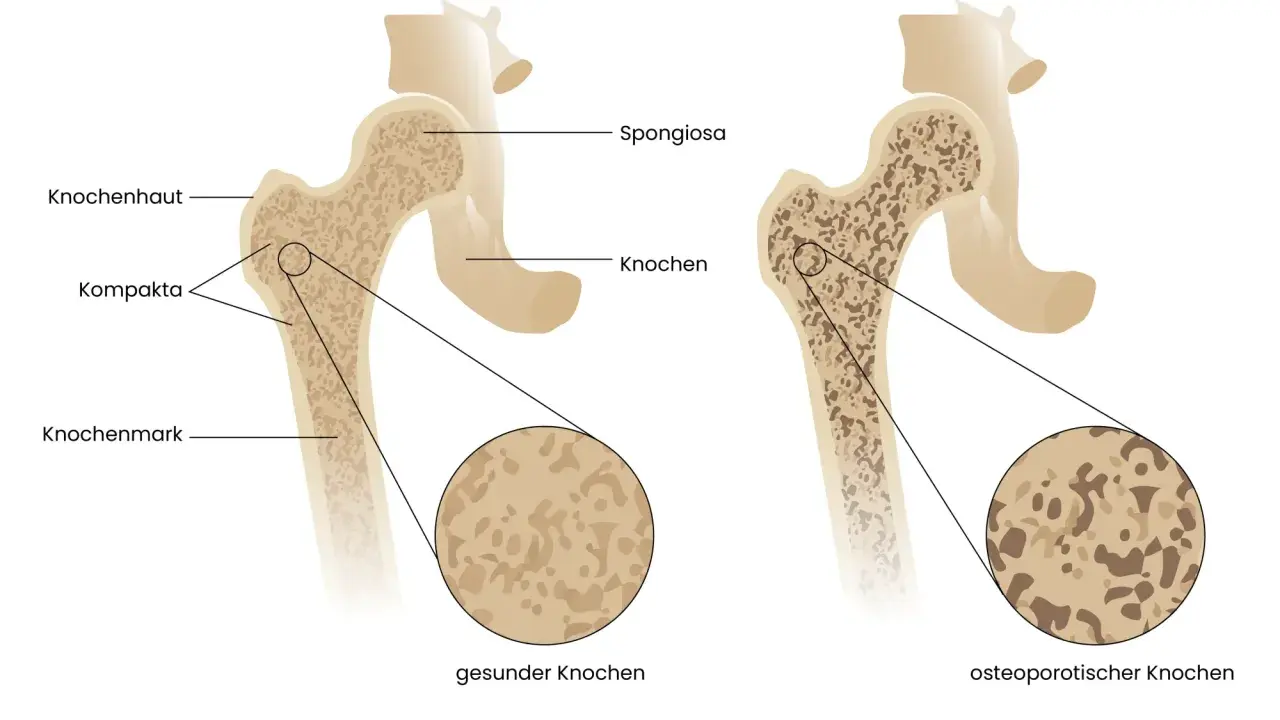 Vergleich gesunder und osteoporotischer Knochen. Rauchen kann Osteoporose fördern, indem es die Knochendichte verringert.