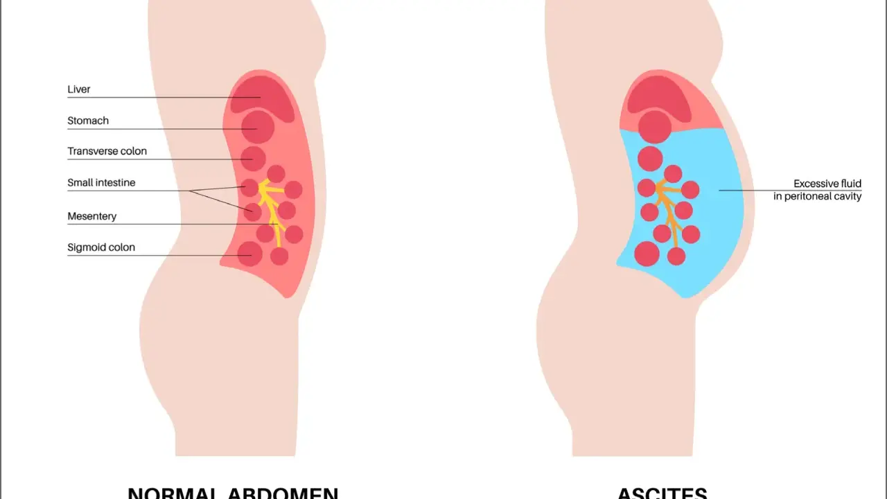 Ilustracja porównująca prawidłowy brzuch z brzuchem z wodobrzuszem (ascites), pokazująca nagromadzenie płynu.