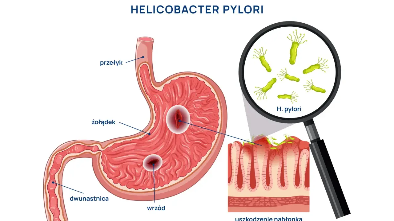 Helicobacter pylori powoduje wrzody żołądka i dwunastnicy, uszkadzając nabłonek. Objawy jelitowe mogą być związane z tym stanem.