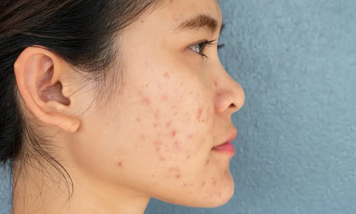 Profil d'une jeune femme avec des marques d'acné sur le visage. Des conseils sur comment enlever les cicatrices d'acné peuvent aider à retrouver une peau nette.