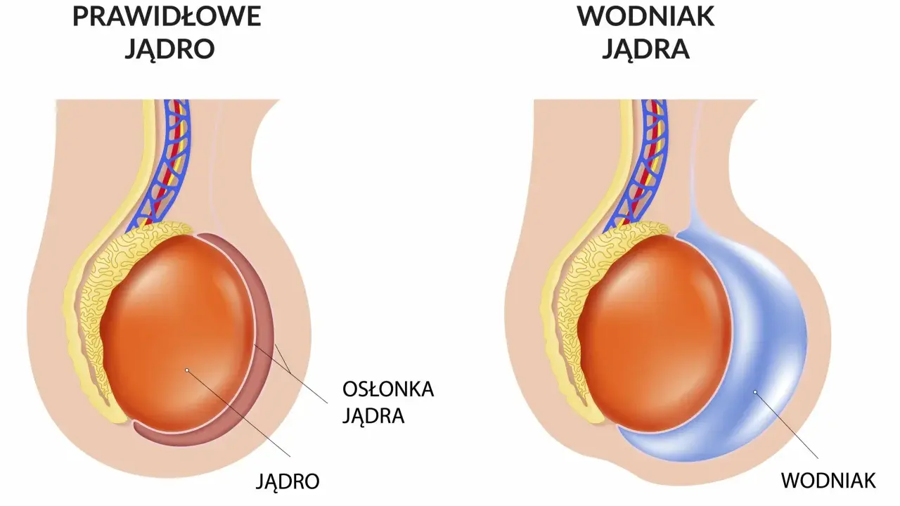 Porównanie prawidłowego jądra z wodniakiem jądra, który może pojawić się po operacji przepukliny pachwinowej.