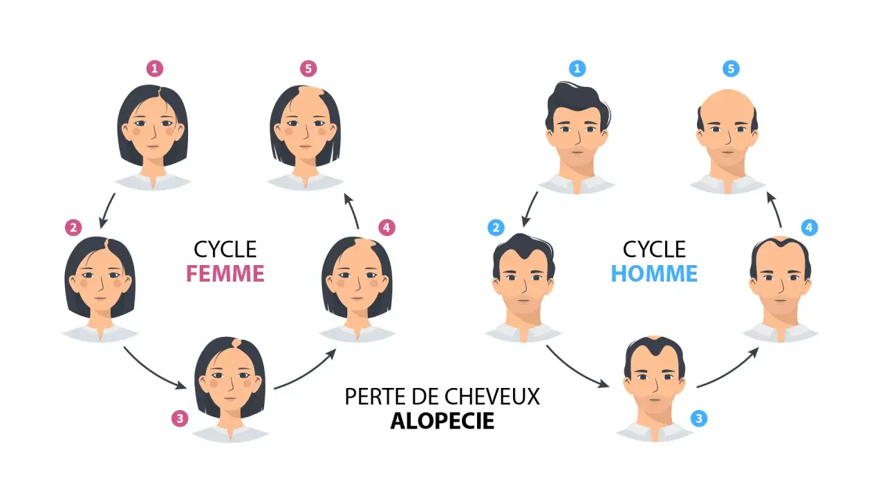 Illustration du cycle de la perte de cheveux, montrant l'alopécie chez la femme et l'homme.