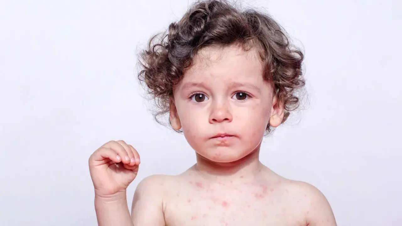 Bambino con puntini rossi sul corpo e viso, possibili puntini rossi eritema solare bambini.