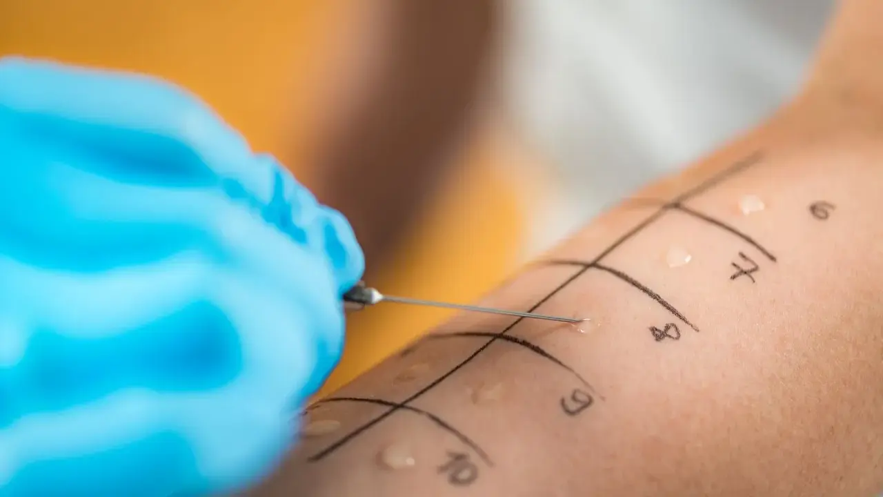 Ręka z zaznaczonymi polami do testów alergicznych skórnych. Igła wprowadza alergen, rozpoczynając diagnostykę.