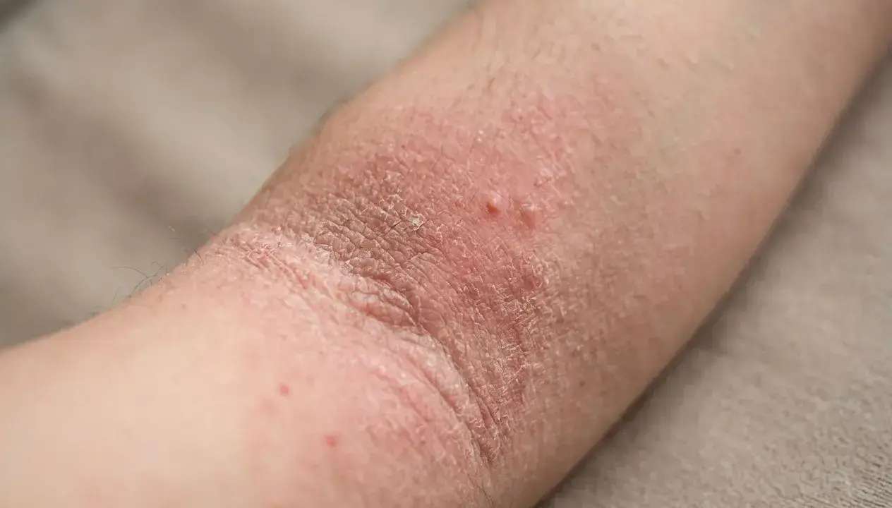 Bras atteint de dermatite atopique, avec peau rouge, sèche et squameuse, quelques petites vésicules.