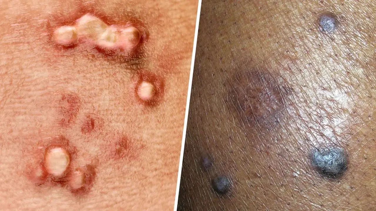 Primer plano de verrugas negras genitales y otras lesiones cutáneas.